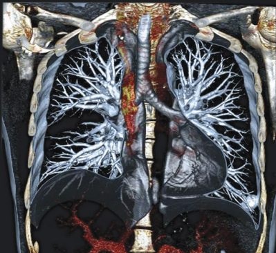 CT a toracelui care arată cum se face, pregătirea pentru tomografie computerizată
