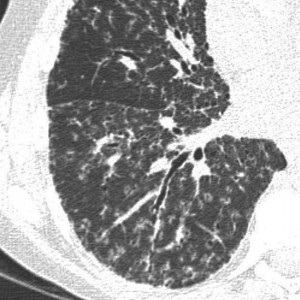 CT în sarcoidoză, diagnosticul de sarcoidoză pulmonară