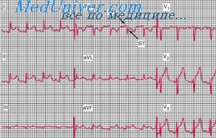 Ku infarct miocardic - tratamentul inimii