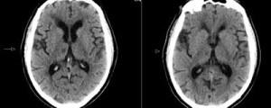 Lacunar ischemic cerebral accident vascular cerebral simptome și cauze de dezvoltare
