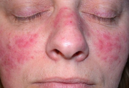 Remedierea cu laser a acneei