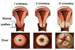 Tratamentul displaziei cervicale de 1, 2, 3 grade în zona de coastă din Sankt Petersburg