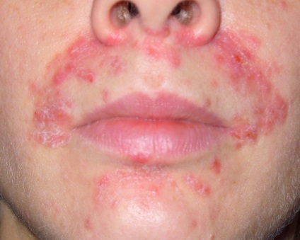 Tratamentul eczemelor și modul de tratare a acestora
