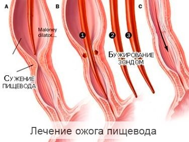 Лечение на рак на хранопровода изгаря при деца