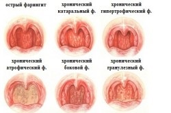 Tratamentul faringitei cronice