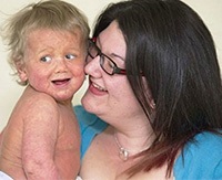 Mastocitoza la adulți și copii provoacă și tratamentul mastocitozelor sistemice ale pielii