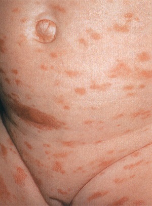 Мастоцитоз у дорослих і дітей причини і лікування системного мастоцитоз шкіри