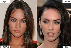 Megan Fox eredménye műtét előtt és után