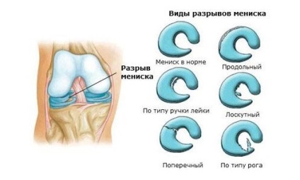 Меніск колінного суглоба, лікування пошкоджень зсувів і запалень, лікувальний ЛФК