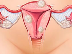 Iomul uterului în perioada menopauzei prezintă simptome și tratament