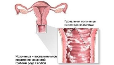 Мірамістин складу препарату, застосування для дітей від року і дорослих, протипоказання