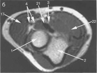 MRI anatómiája könyökízület