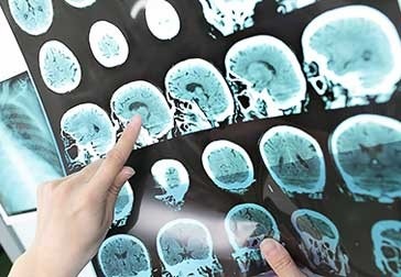 MRI diagnózis agydaganat (agy gyermek) MRI diagnózis agydaganat