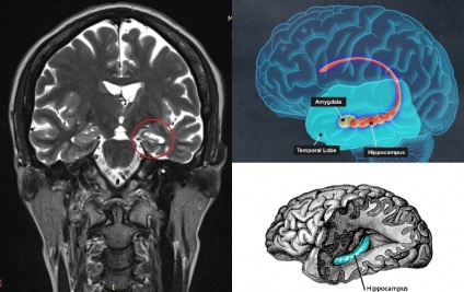 Mirt la epilepsie în clinici pato