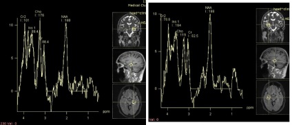 MRI epilepsziában klinikák Patero