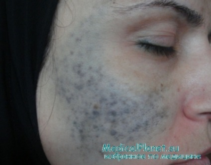 Nevus ota