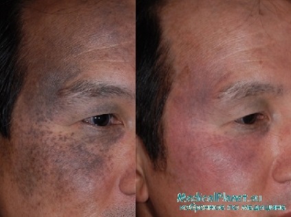 Nevus ota - oftalmic-maxilar albastru închis