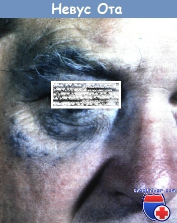 Nevus ota - oftalmic-maxilar albastru închis