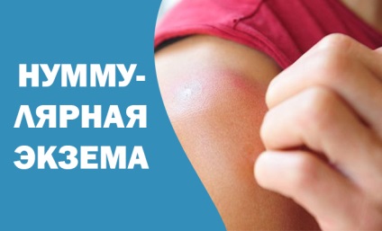 Нуммулярная екзема і способи її лікування