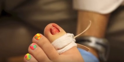 Tratamentul de onicoliză la domiciliu - degete și degetele de la picioare
