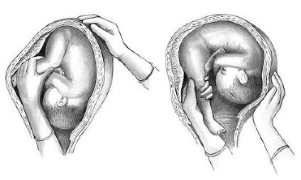 Operațiile care corectează anomaliile fetale (rândul obstetric)