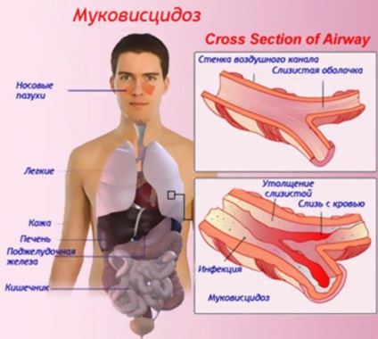 Akut bronchitis tünetek és a kezelés gyermekekben obstruktív, mint egy élvezet, kórtörténet