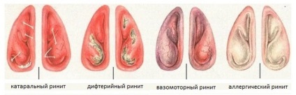 Simptome și tratament al rinitei acute, ce este, etapele și ce trebuie tratate