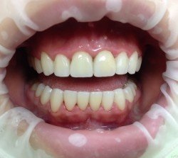 Відбілювання зубів - клініка сучасної стоматології Жулебіно