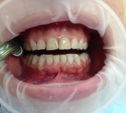Albirea dintilor - Clinica de stomatologie moderna Zhulebino