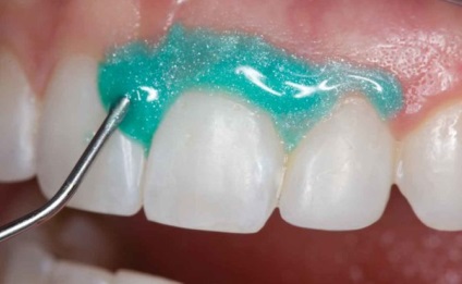 Відбілювання зубів системою opalescence - домашнє і професійне, opalescence xtra boost