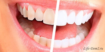 Albirea dinților acasă - cât de realistă este