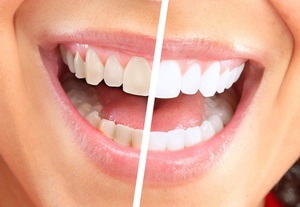 Избелване на зъби в домашни условия са най-честите и ефективни начини, мнения