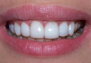 Избелване на зъби в домашни условия са най-честите и ефективни начини, мнения