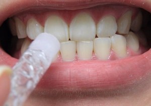 Albirea dinților la domiciliu este cea mai comună și eficientă metodă, recenzii