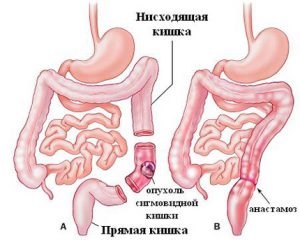 Palparea tehnicii de colon sigmoid