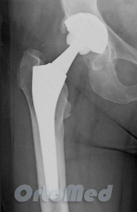 Egy pár súrlódó hip arthroplastica