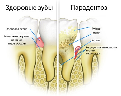 Пародонтоз фото, чи можна його вилікувати і причини виникнення захворювання