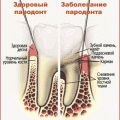 Fotografia cu parodontoză, poate fi vindecată și cauza bolii