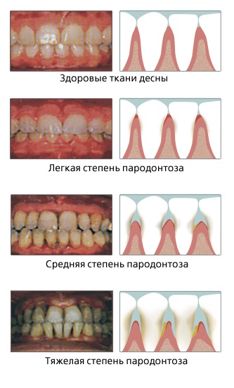 Пародонтоз фото, чи можна його вилікувати і причини виникнення захворювання