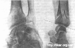 Fracturarea razei într-un loc tipic (fractura coli)