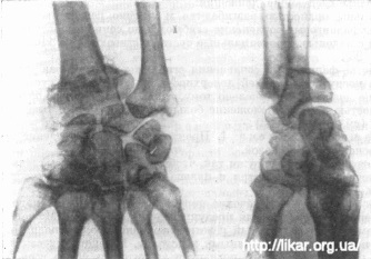 Fracturarea razei într-un loc tipic (fractura coli)