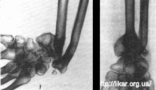 Fracturarea razei într-un loc tipic (fractura coli)