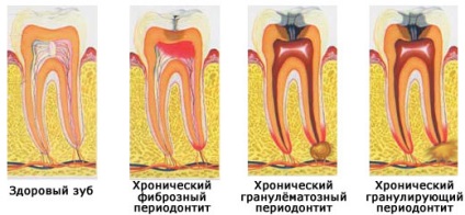 Періодонтит - причини, симптоми, лікування