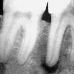 A periodontitis - okai, tünetei, kezelése