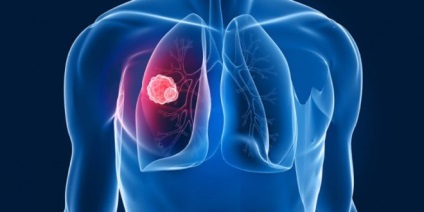 Carcinomul celulelor scuamoase din stadiul pulmonar și prognosticul