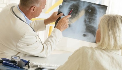 Carcinomul celulelor scuamoase din stadiul pulmonar și prognosticul