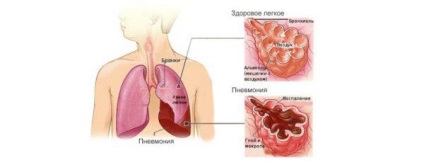 Simptome de pneumonie la adulți cu o temperatură de 37, 38, 39, pneumonie atipică, semne