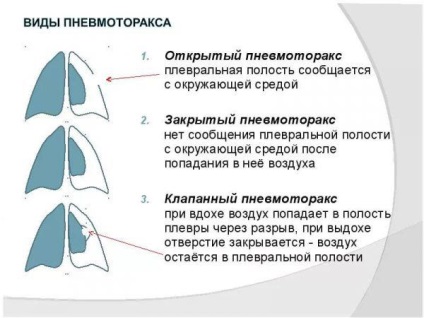 Simptome de pneumonie la adulți cu o temperatură de 37, 38, 39, pneumonie atipică, semne