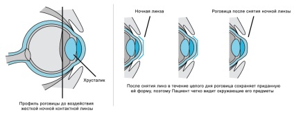 Selectarea lentilelor de contact orthokeratologice de noapte în Moscova