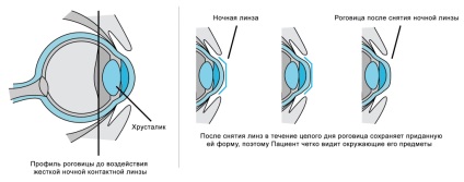 Válogatás az éjszakai Orthokeratology kontaktlencsék Moszkvában